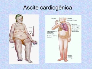 Ascite cardiogênica 
•Edema de membros 
•Dispneia aos esforços 
•Dispneia paroxística 
noturna 
•Taquicardia/ bradicardia ...