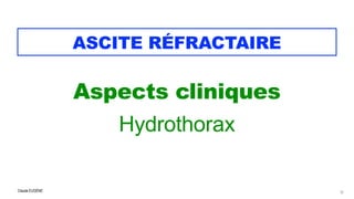 Claude EUGÈNE
ASCITE RÉFRACTAIRE
Aspects cliniques


Hydrothorax


12
 