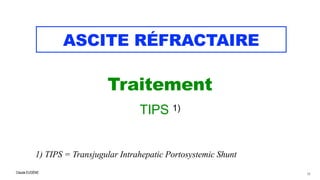 Claude EUGÈNE
ASCITE RÉFRACTAIRE
Traitement

 TIPS 1)


1) TIPS = Transjugular Intrahepatic Portosystemic Shunt
55
 