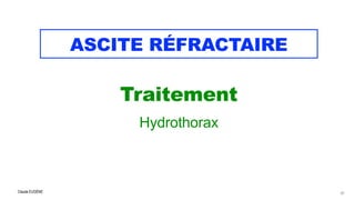 Claude EUGÈNE
ASCITE RÉFRACTAIRE
Traitement

 Hydrothorax
67
 