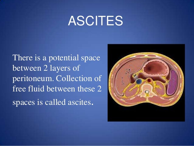 ascites-and-sbp