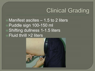 Manifest ascites – 1.5 to 2 liters
Puddle sign 100-150 ml
Shifting dullness 1-1.5 liters
Fluid thrill >2 liters
 