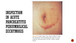 Ascites.Acute Abdomen.Ph.Examination.LN1A.pptx