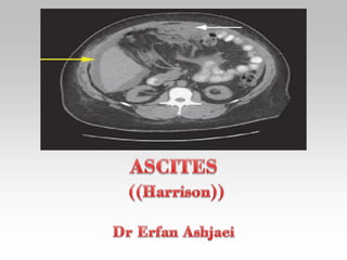 Ascites1