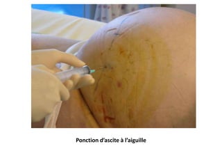 Ponction d’ascite à l’aiguille
 