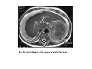 Ascite importante chez un patient cirrhotique
 