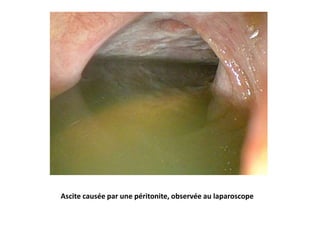Ascite causée par une péritonite, observée au laparoscope
 