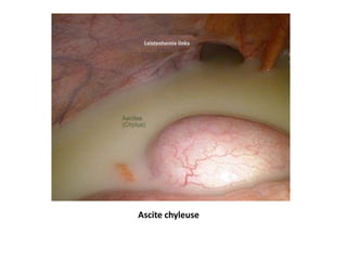 Ascite chyleuse
 