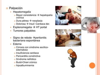 PercusiónEpigastrio Abdomen inferior matidez con concavidad superiorMatidez desplazableSigno de la onda asciticaPaciente con distensión abdominalAscitis: