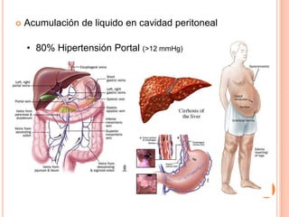 Acumulación de liquido en cavidad peritoneal80% Hipertensión Portal (>12 mmHg)Fisiopatología (en cirrosis)↑ Presión hidrostática sinusoidalFiltración liquido en intersticioInflamación↑ Vasodilatadores (prostaglandinas, NO) Apertura circulación colateral↓Resistencia vascular periférica↓ PA barorreceptoresRenina-AngiotensinaADHSNSHipoalbuminemia