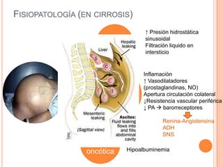 Otras causas de Hipertensión portal