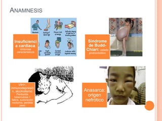 Examen físicoInspección:Distensión abdominal simétricaObligo desplegado o evertidoFlancos abombadosCirculación colateral Arañas vascularesIctericiaPalma hepáticaCirrosis