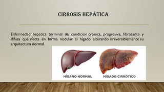 CIRROSIS HEPÁTICA
Enfermedad hepática terminal de condición crónica, progresiva, fibrosante y
difusa que afecta en forma nodular al hígado alterando irreversiblemente su
arquitectura normal.