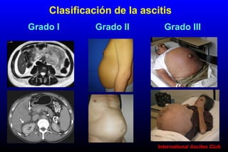 Grado I Grado II Grado III
International Ascites Club
Clasificación de la ascitis
 