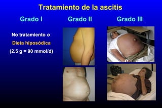 Grado I Grado II Grado III
Tratamiento de la ascitis
No tratamiento o
Dieta hiposódica
(2.5 g = 90 mmol/d)
 