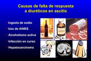 • Ingesta de sodio
• Uso de AINES
• Alcoholismo activo
• Infección en curso
• Hepatocarcinoma
Causas de falta de respuestaCausas de falta de respuesta
a diuréticos en ascitisa diuréticos en ascitis
 