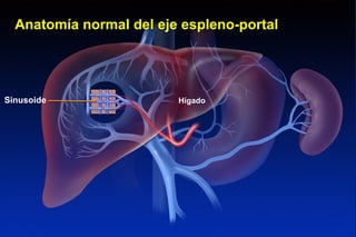 Anatomía normal del eje espleno-portal
Sinusoide Hígado
NORMAL VASCULAR ANATOMY OF THE LIVER
 