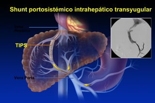 Shunt portosistémico intrahepático transyugular
Vena
Hepática
Vena Porta
TIPS
THE TRANSJUGULAR INTRAHEPATIC PORTOSYSTEMIC SHUNT
 