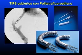 TIPS cubiertos con Politetrafluoroetileno
POLYTETRAFLUOROETHYLENE (e-PTFE)-COVERED TIPS
 
