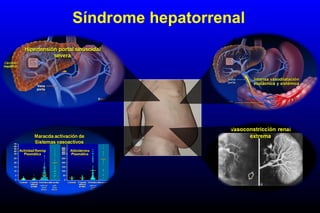 Síndrome hepatorrenal
 