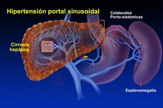 SINUSOIDAL PORTAL HYPERTENSION
Cirrosis
hepática
Hipertensión portal sinusoidal Colaterales
Porto-sistémicas
Esplenomegalia
 