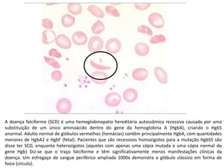 A doença falciforme (SCD) é uma hemoglobinopatia hereditária autossômica recessiva causada por uma substituição de um único aminoácido dentro do gene da hemoglobina A (HgbA), criando o HgbS anormal. Adulto normal de glóbulos vermelhos (hemácias) contêm principalmente HgbA, com quantidades menores de HgbA2 e HgbF (fetal). Pacientes que são recessivos homozigotos para a mutação HgbSS são disse ter SCD, enquanto heterozigotos (aqueles com apenas uma cópia mutada e uma cópia normal do gene Hgb) Diz-se que o traço falciforme e têm significativamente menos manifestações clínicas da doença. Um esfregaço de sangue periférico ampliada 1000x demonstra o glóbulo clássico em forma de foice (círculo). 