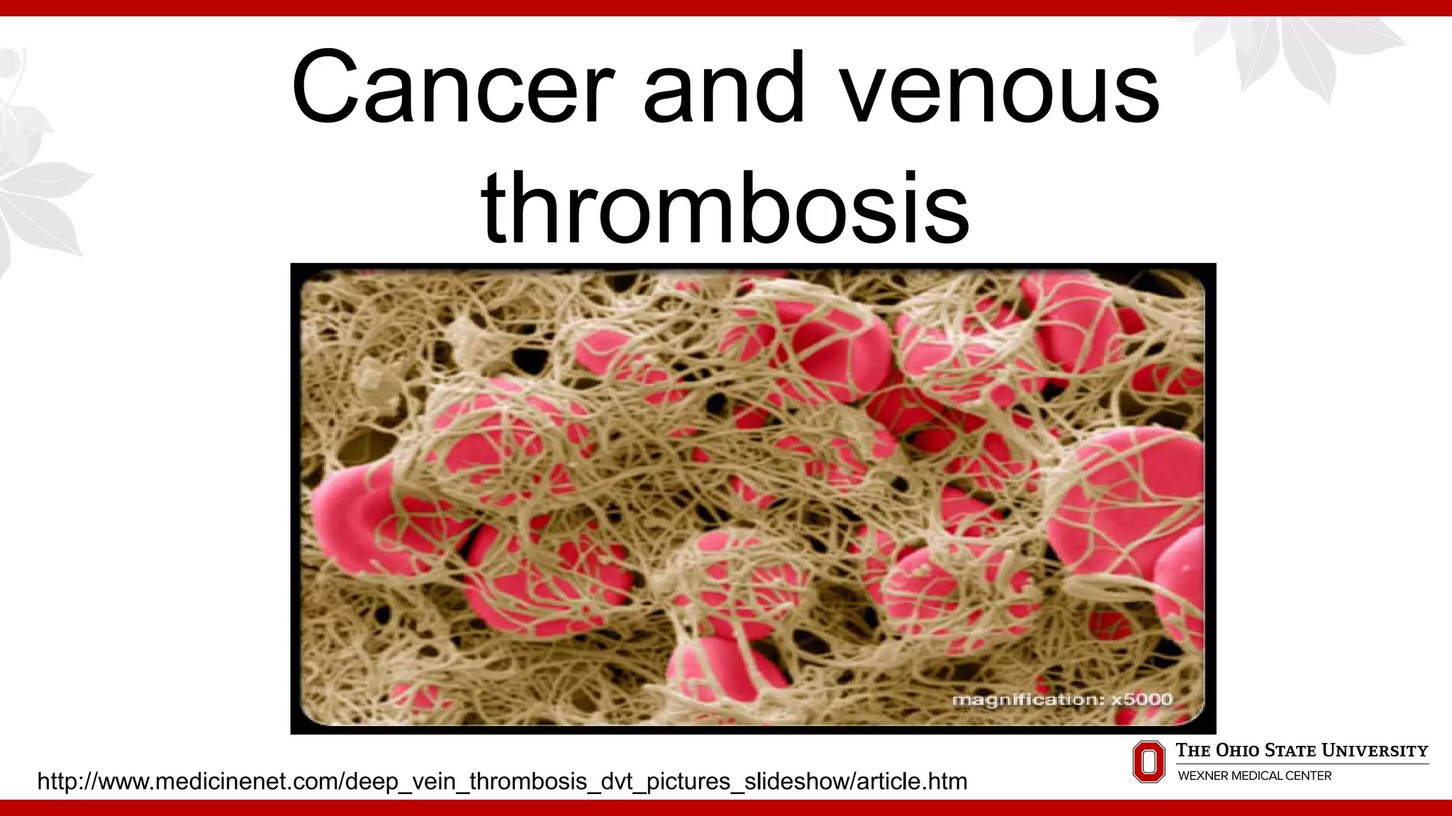 Cancer and venous
thrombosis
http://www.medicinenet.com/deep_vein_thrombosis_dvt_pictures_slideshow/article.htm
 