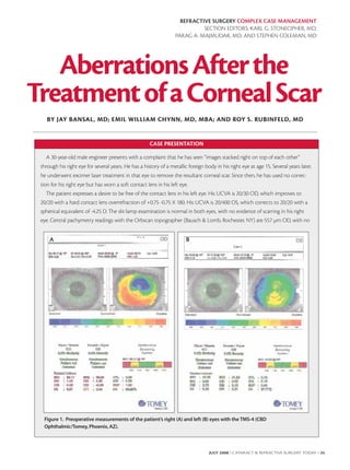 REFRACTIVE SURGERY COMPLEX CASE MANAGEMENT
                                                                             SECTION EDITORS: KARL G. STONECIPHER, MD;
                                                                   PARAG A. MAJMUDAR, MD; AND STEPHEN COLEMAN, MD




   Aberrations After the
Treatment of a Corneal Scar
    BY JAY BANSAL, MD; EMIL WILLIAM CHYNN, MD, MBA; AND ROY S. RUBINFELD, MD


                                                      CASE PRESENTATION

    A 30-year-old male engineer presents with a complaint that he has seen “images stacked right on top of each other”
 through his right eye for several years. He has a history of a metallic foreign body in his right eye at age 15. Several years later,
 he underwent excimer laser treatment in that eye to remove the resultant corneal scar. Since then, he has used no correc-
 tion for his right eye but has worn a soft contact lens in his left eye.
    The patient expresses a desire to be free of the contact lens in his left eye. His UCVA is 20/30 OD, which improves to
 20/20 with a hard contact lens overrefraction of +0.75 -0.75 X 180. His UCVA is 20/400 OS, which corrects to 20/20 with a
 spherical equivalent of -4.25 D. The slit-lamp examination is normal in both eyes, with no evidence of scarring in his right
 eye. Central pachymetry readings with the Orbscan topographer (Bausch & Lomb, Rochester, NY) are 557 µm OD, with no


     A                                                                  B




  Figure 1. Preoperative measurements of the patient’s right (A) and left (B) eyes with the TMS-4 (CBD
  Ophthalmic/Tomey, Phoenix, AZ).



                                                                                   JULY 2008 I CATARACT & REFRACTIVE SURGERY TODAY I 35
 