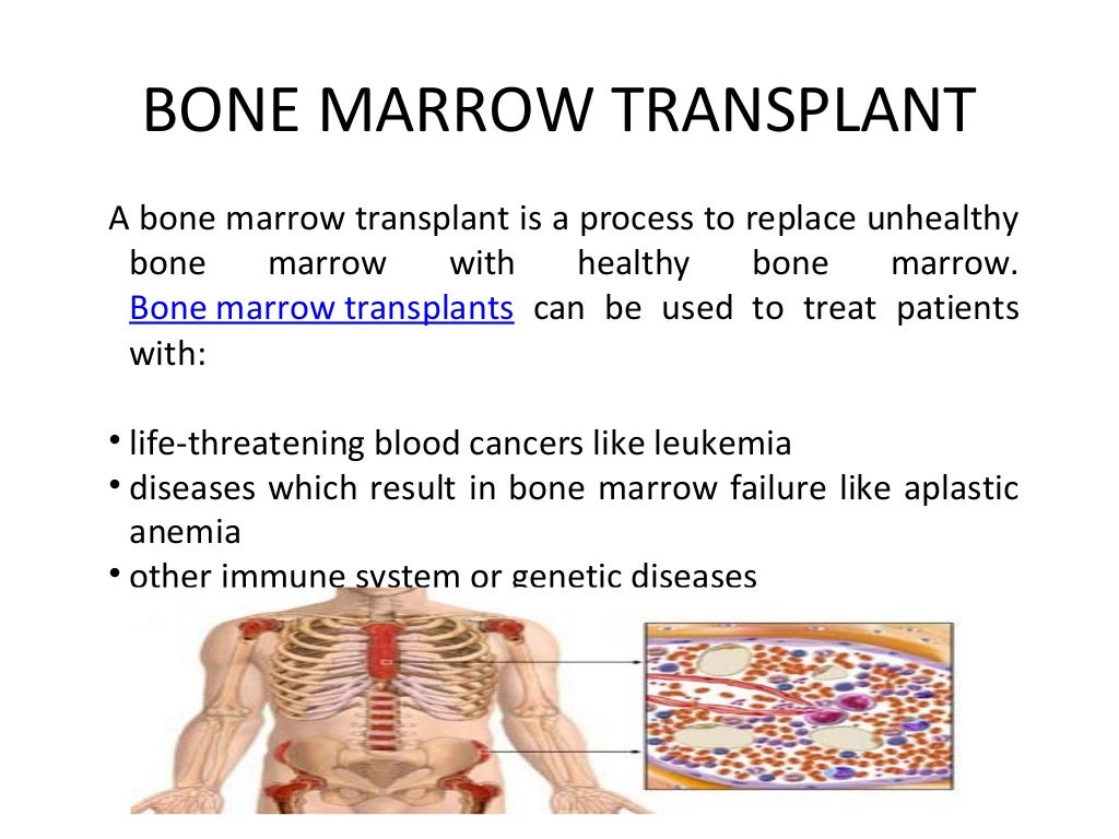 autologous bone marrow transplant