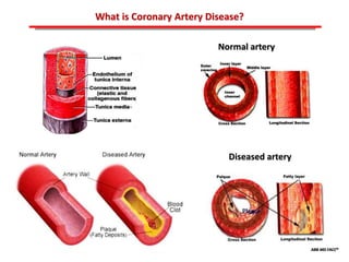 ABB MD FACC©
What is Coronary Artery Disease?
Normal artery
Diseased artery
 