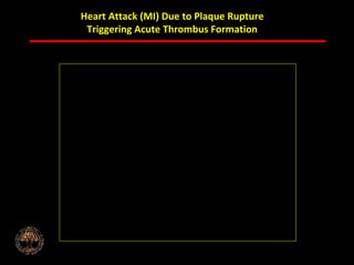 ABB MD FACC©
Heart Attack (MI) Due to Plaque Rupture
Triggering Acute Thrombus Formation
 