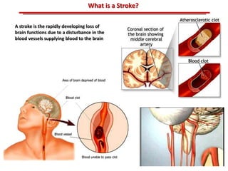 ABB MD FACC©
What is a Stroke?
A stroke is the rapidly developing loss of
brain functions due to a disturbance in the
blood vessels supplying blood to the brain
 