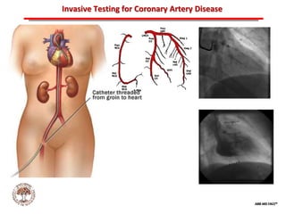 ABB MD FACC©
Invasive Testing for Coronary Artery Disease
 