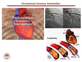 ABB MD FACC©
Percutaneous Coronary Intervention
 