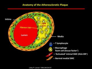 ABB MD FACC©
Libby P. Lancet. 1996;348:S4-S7.
Media
– T lymphocyte
– Macrophage
foam cell (tissue factor+)
– ‘Activated’ intimal SMC (HLA-DR+)
– Normal medial SMC
Fibrous cap
Intima
Lipid
core
Lumen
Anatomy of the Atherosclerotic Plaque
 