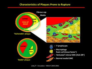 ABB MD FACC©
Libby P. Circulation. 1995;91:2844-2850.
Characteristics of Plaques Prone to Rupture
– T lymphocyte
– Macrophage
foam cell (tissue factor+)
– ‘Activated’ intimal SMC (HLA-DR+)
– Normal medial SMC
‘Stable’ plaque
‘Vulnerable’ plaque
Lumen
Area of
detail
Media
Fibrous cap
Lumen
Lipid
core
Lipid
core
 