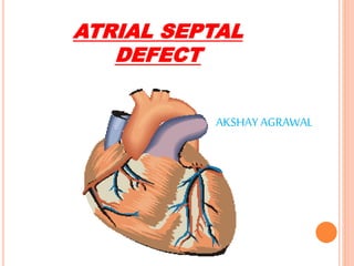 ATRIAL SEPTAL
DEFECT
AKSHAY AGRAWAL
 