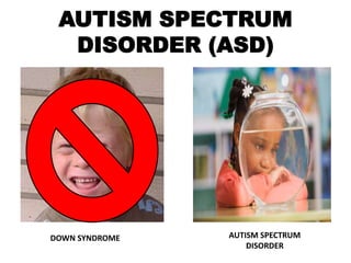AUTISM SPECTRUM
DISORDER (ASD)
DOWN SYNDROME AUTISM SPECTRUM
DISORDER
 
