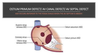 OSTIUM PRIMUM DEFECT/ AV CANAL DEFECT/ AV SEPTAL DEFECT
ASD OCCURS ANTERIOR TO THE FOSSA OVALIS WHEN THE AV SEPTUM IS ABSENT.
 
