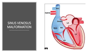 SINUS VENOSUS
MALFORMATION
 