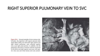 RIGHT SUPERIOR PULMONARY VEIN TO SVC
 