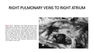 RIGHT PULMONARY VEINS TO RIGHT ATRIUM
 