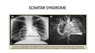 SCIMITAR SYNDROME
 
