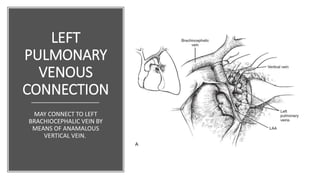 LEFT
PULMONARY
VENOUS
CONNECTION
MAY CONNECT TO LEFT
BRACHIOCEPHALIC VEIN BY
MEANS OF ANAMALOUS
VERTICAL VEIN.
 