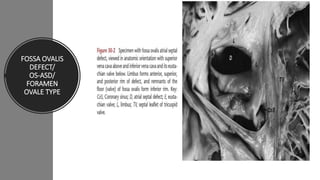 FOSSA OVALIS
DEFECT/
OS-ASD/
FORAMEN
OVALE TYPE
 