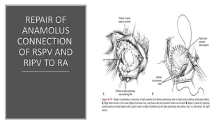 REPAIR OF
ANAMOLUS
CONNECTION
OF RSPV AND
RIPV TO RA
 