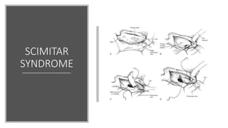 SCIMITAR
SYNDROME
 