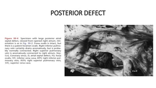 POSTERIOR DEFECT
 
