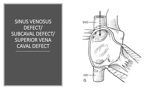 SINUS VENOSUS
DEFECT/
SUBCAVAL DEFECT/
SUPERIOR VENA
CAVAL DEFECT
 