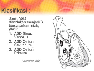 Jenis ASD
dibedakan menjadi 3
berdasarkan letak,
yaitu:
1. ASD Sinus
Venosus
2. ASD Ostium
Sekundum
3. ASD Ostium
Primum
(Sommer RJ, 2008)
Klasifikasi :
 